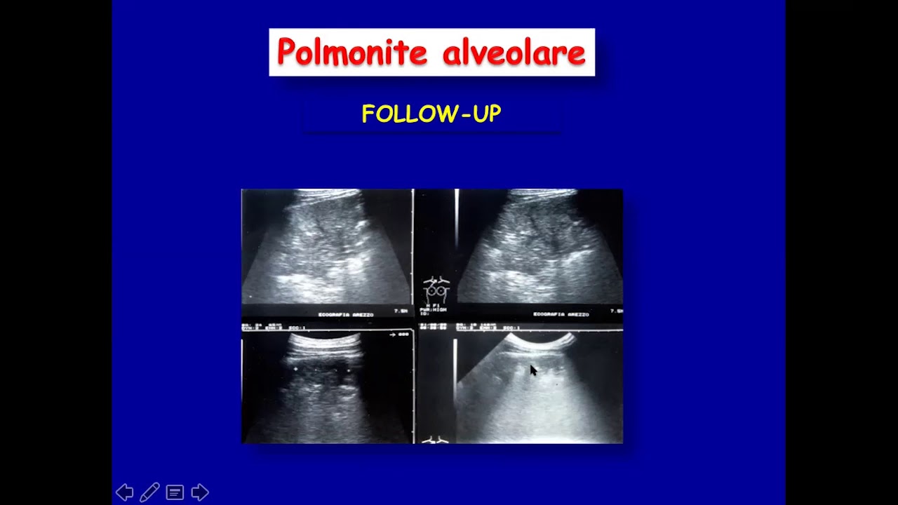 Ecografia Nelle Polmoniti E Nelle Pneumopatie Infettive | Diretteweb